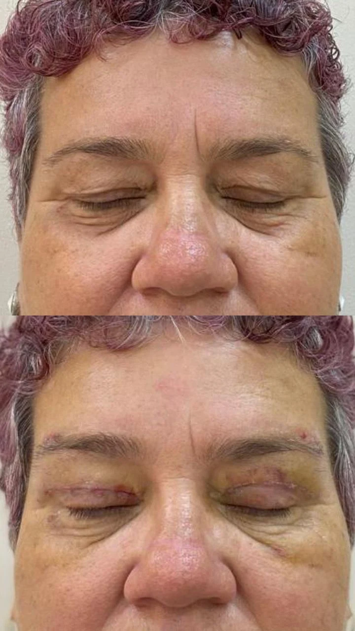 Registro comparativo de blefaroplastia, imagem 4 enviada pela clínica